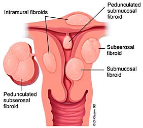 Uterine Fibroids & Austin Fertility