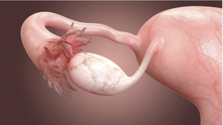 fallopian-tubes-blocked-hydrosalpinx-female-fertility