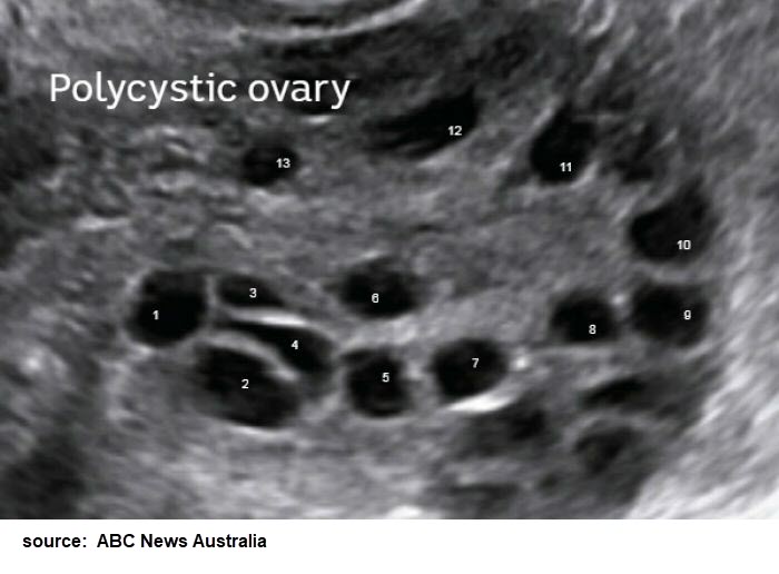 PCOS-ovary-ABC-News-Australia